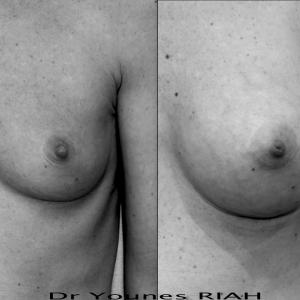 Augmentation mammaire par protheses