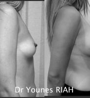 Augmentation mammaire Dr Younes RIAH Chirurgie Esthétique