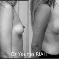 Augmentation mammaire Dr Younes RIAH Chirurgie Esthétique