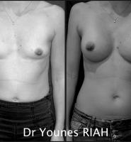 Augmentation mammaire Dr Younes RIAH Chirurgie Esthétique