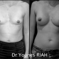 Augmentation mammaire Dr Younes RIAH Chirurgie Esthétique