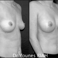 Augmentation mammaire Dr Younes RIAH Chirurgie Esthétique