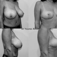 Réduction mammaire Dr Younes RIAH Chirurgie Esthétique