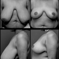 Réduction mammaire Dr Younes RIAH Chirurgie Esthétique