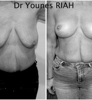 Lifting des seins Dr Younes RIAH Chirurgie Esthétique