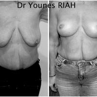 Lifting des seins Dr Younes RIAH Chirurgie Esthétique