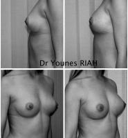 Augmentation mammaire par injection de graisse Dr Younes RIAH Chirurgie Esthétique