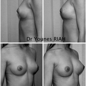 Augmentation mammaire par injection de graisse